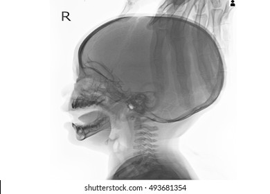 Xray Skull In Patient Young Child And Show Hydrocephalus