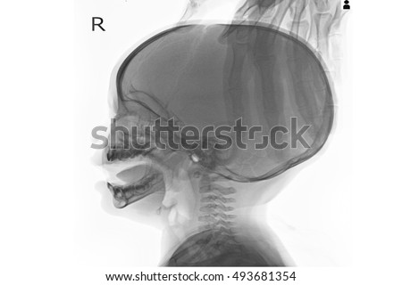 xray skull in patient young child and show hydrocephalus