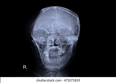 Xray Skull Show Post Operation Craniotomy