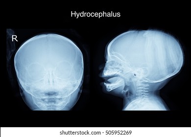 Xray Skull In The You Child Show Hydrocephalus 