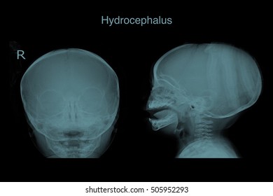 Xray Skull In The You Child Show Hydrocephalus 