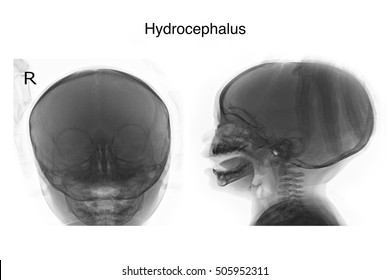 Xray Skull In The You Child Show Hydrocephalus 