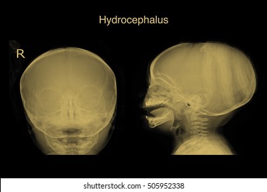 Xray Skull In The You Child Show Hydrocephalus 