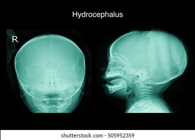 Xray Skull In The You Child Show Hydrocephalus 