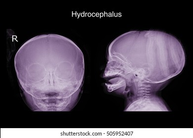 Xray Skull In The You Child Show Hydrocephalus 