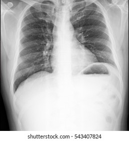 X-ray Small Calcification About 1 Cm At LUL Is Shown Possibly Bone Island, Calcific Lung Nodule Or Etc