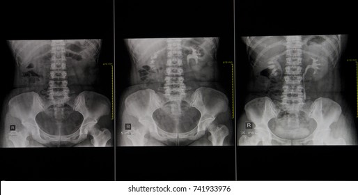 X-ray Special diagnostic radiology of the urinary tract.IVP (Intra-Venous Pyelography ),IVU(Intra-Venous Urography)