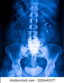 Xray Of Stomach And Pelvis Section