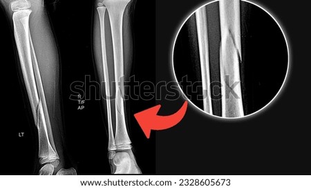 X-Ray Tibia Fibula Ap lateral with tibia fracture. Fracture type is spiral.