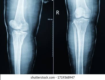 X-ray Tibia include knee (AP,LATERAL)udrer long leg cast finding fracture proximal metaphysis of tibia.Healthcare and insurance concept.