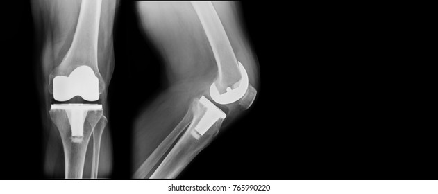 x-ray total knee replacement