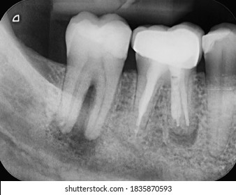 X-ray of two human tooth molars, both showing infections. One has an abscess and one has been root canal treated already and has a crown. Endodontic therapy.