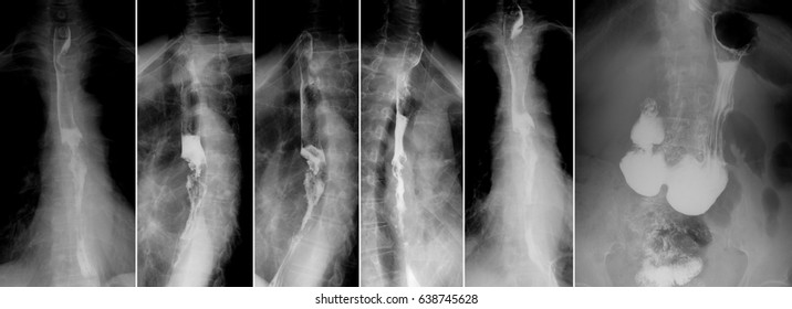 X-ray Of The Upper Gastrointestinal Series (UGI) With Barium. Cancer Of The Esophagus.
