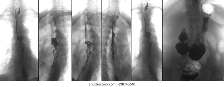 X-ray Of The Upper Gastrointestinal Series (UGI) With Barium. Cancer Of The Esophagus. Negative.