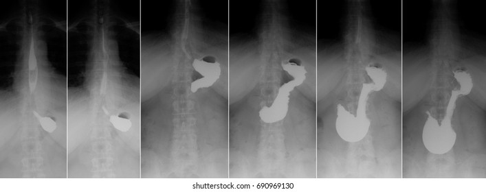 X-ray Of The Upper Gastrointestinal Series (UGI) With Barium. Cancer Of The Cardiac Part Of The Stomach.