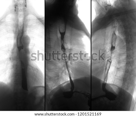 X-ray of the upper gastrointestinal series (UGI) with barium. Cancer of the esophagus. Negative.
Radiology of the upper gastrointestinal series (UGI) with barium. Cancer of the esophagus.