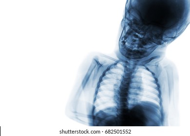 X-ray Upper Half Body Of Child And Blank Area At Left Side .