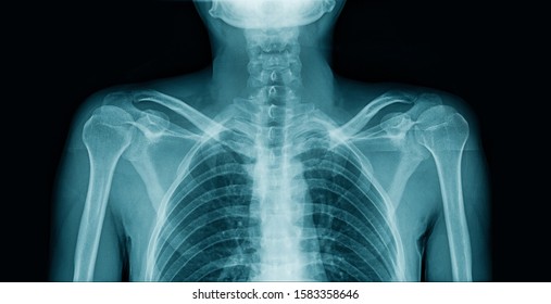 X-ray Upper Part Of Human Body