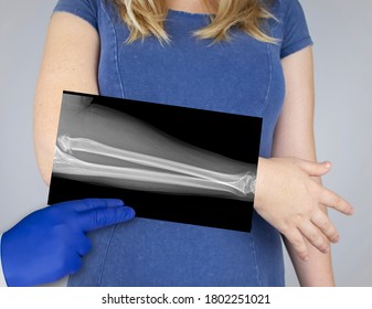 X-ray of a woman's forearm. A photograph of the spoke-bone and ulna bones is brought to the patient's hand. Radiologist examine X-ray examination. - Shutterstock ID 1802251021