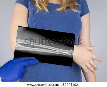 X-ray of a woman's forearm. A photograph of the spoke-bone and ulna bones is brought to the patient's hand. Radiologist examine X-ray examination.