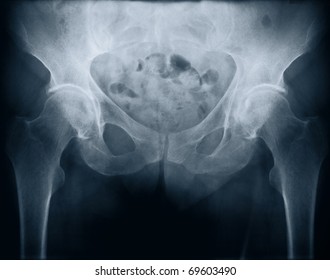 X-ray Of A Woman's Pelvis