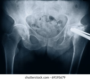 X-ray Of A Woman's Pelvis With Bolt