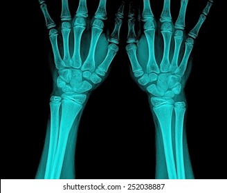 Xray Of A Wrist