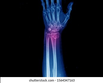 X-ray of wrist and forearm showing closed fracture with displacement of distal radius and ulnar styloid process. The patient needs open reduction and internal fixation of the fracture.