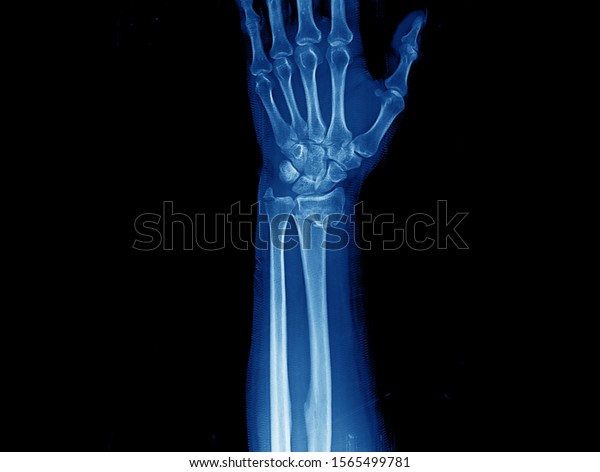 X Ray Of Wrist And Forearm Showing Closed Fracture With Displacement Of Distal Radius And Ulnar 0246