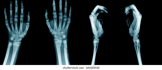 X-ray Wrist Fracture