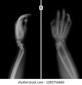 Xray Wrist Greenstick Fracture Radius Stock Photo 1283756860 | Shutterstock