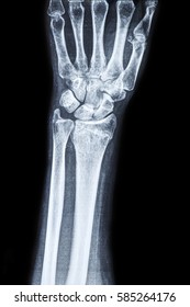 X Ray Cast Broken Wrist Internal Stock Photo (Edit Now) 271275509