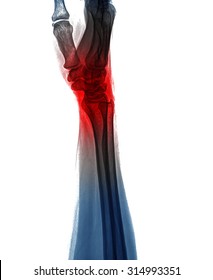 Xray Of Wrist , Isolate On White Background