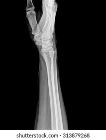 Xray Of Wrist , Side View