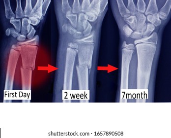 x-ray wrist three views show fracture distal radius (forearm's bone)on red color mark and step bone union.