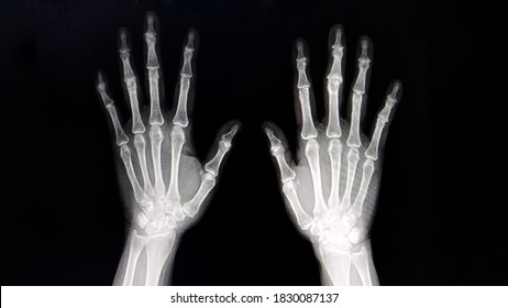 X-rayed human hand. X-ray of hand bones. Both hand ap or PA.  - Shutterstock ID 1830087137