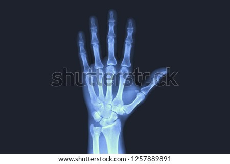 X-rayed human hand. X-ray of hand bones