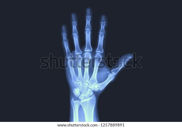 X-rayed human hand. X-ray\
of hand bones