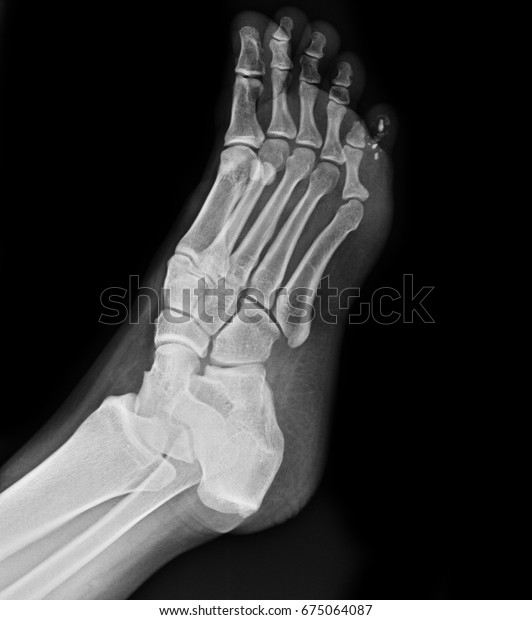 X-rays image of foot\
fracture patients