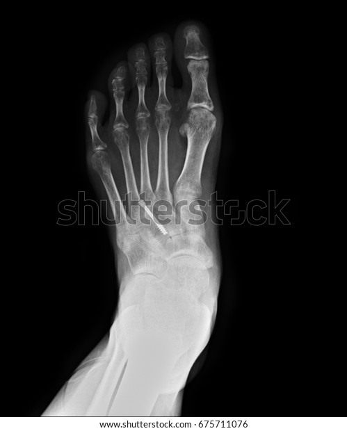 X-rays image of foot
fracture patients