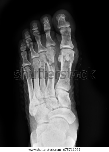 X-rays image of foot\
fracture patients