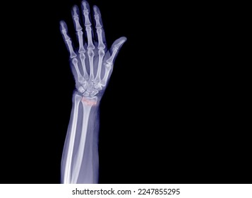 X-rays show a fractured wrist that feels painful. - Shutterstock ID 2247855295
