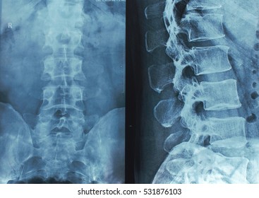 Spine Xray High Res Stock Images Shutterstock