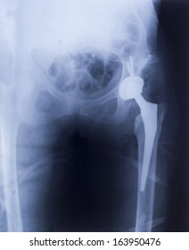 X-rey - Artificial Hip Implant