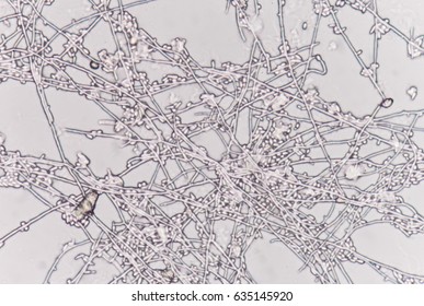 Yeast Cells In Urine Sample.