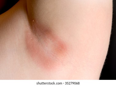 Yeast Infection In An Armpit