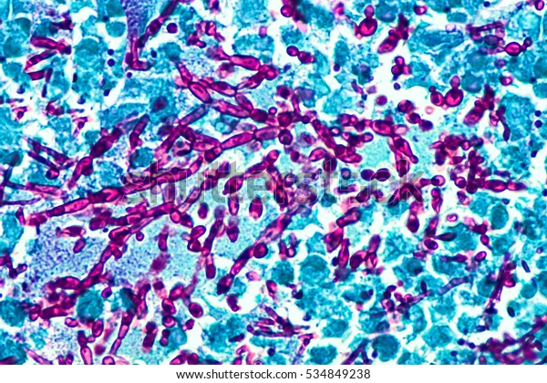 酵母感染 念珠菌的萌芽酵母和偽偽偽偽 染有週期性酸schiff Pas 染色 這種真菌通常影響陰道和外陰 口服 鵝口瘡 和尿布疹 庫存照片