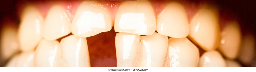 Yellow Bad Teeth. Yellow Teeth. Bad Dental Health, No Teeth, No Fluoride, Tooth Erosion. Man Without One Front Tooth. No Teeth. Smile Men With A Lost Front Tooth, Toothache.