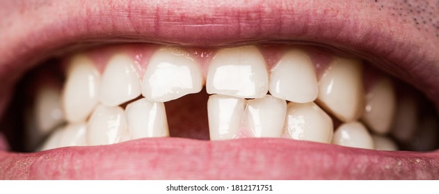 Yellow Bad Teeth. Smile Men With A Lost Front Tooth, Toothache. Man Without One Front Tooth. No Teeth. Yellow Teeth. Bad Dental Health, No Teeth, No Fluoride, Tooth Erosion.