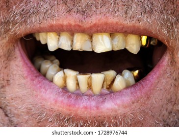 Yellow Crooked Teeth Of A Smoker, Close-up